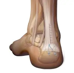 Achilles Tendon Reconstruction