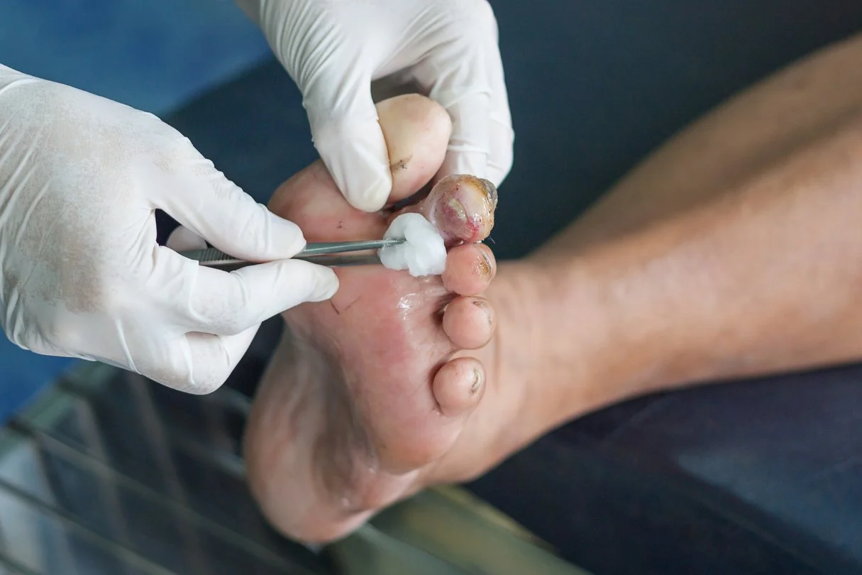 Surgical Debridement