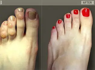 Hammertoe Correction