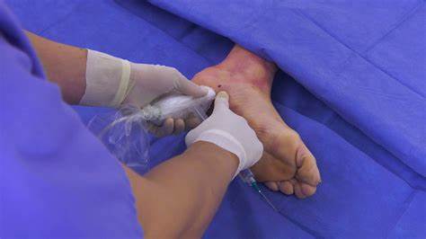 Plantar bone growth removal